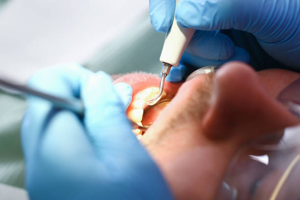 Best Emergency Root Canal Treatment in Unionville, TN